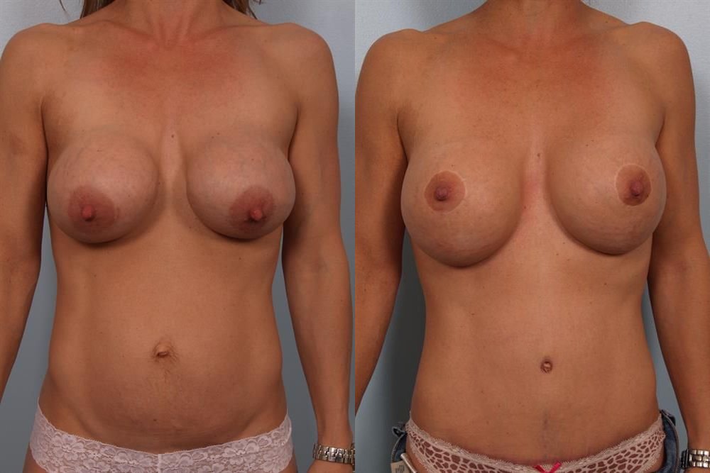 Breast Lift (Mastopexy) 5