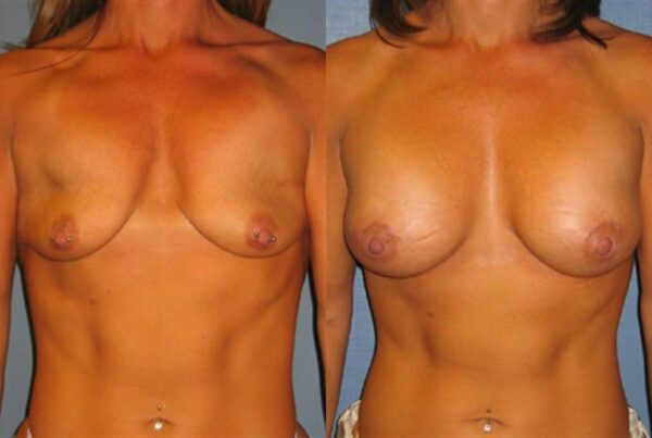 Breast Lift (Mastopexy) 50