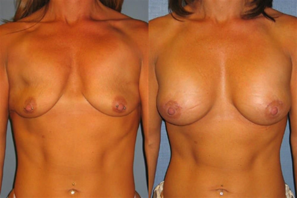 Breast Lift (Mastopexy) 50