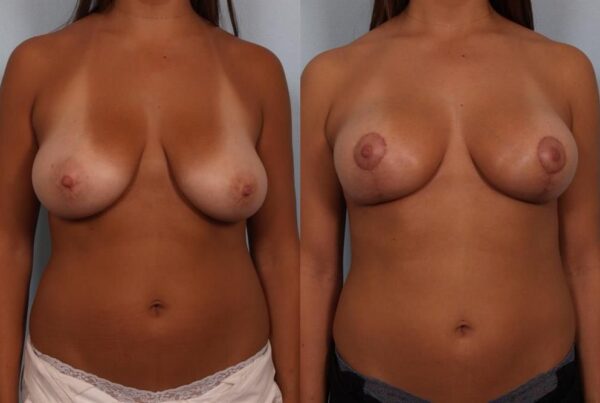 Breast Lift (Mastopexy) 51