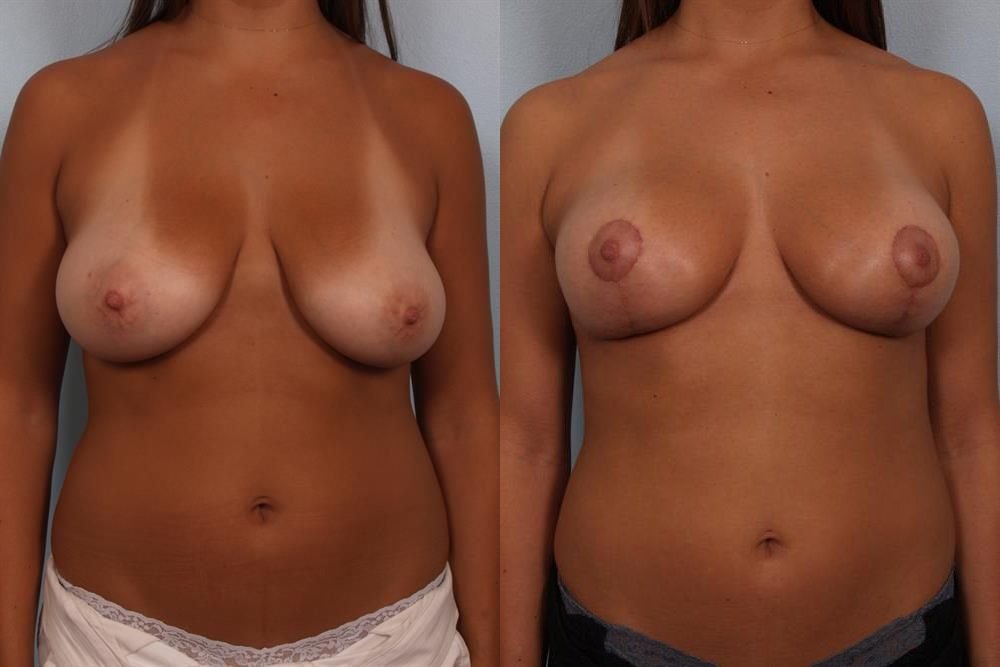 Breast Lift (Mastopexy) 51