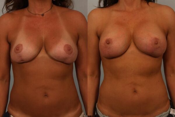 Breast Lift (Mastopexy) 52