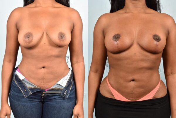 Breast Lift (Mastopexy) 53