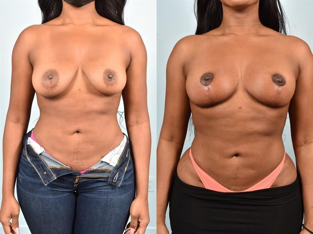 Breast Lift (Mastopexy) 53