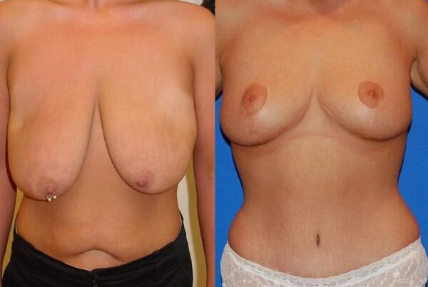 Breast Lift (Mastopexy) 54