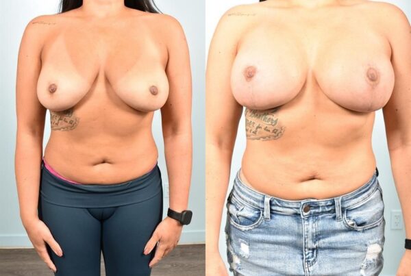 Breast Lift (Mastopexy) 55