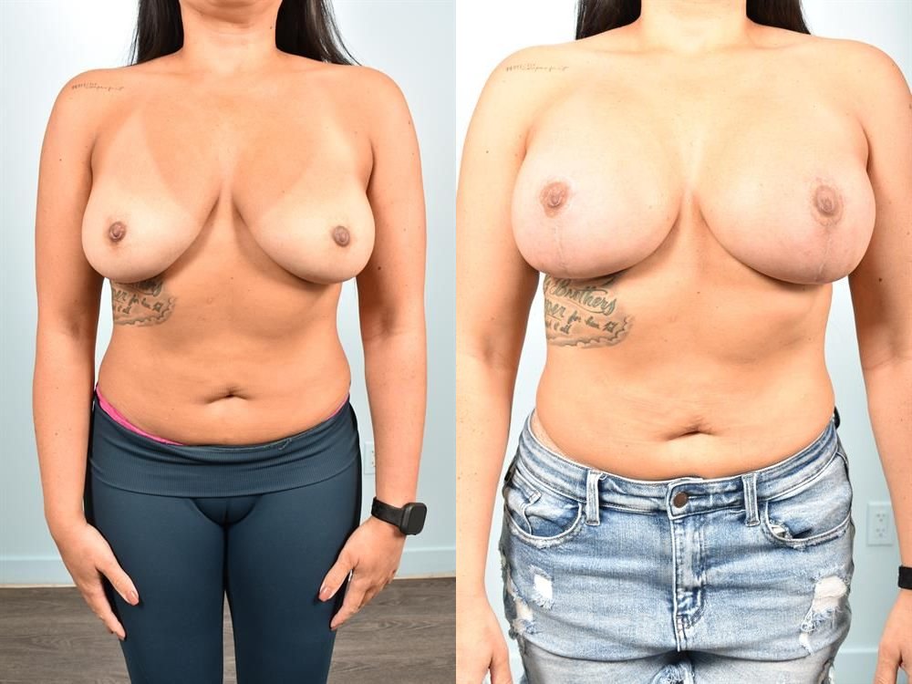 Breast Lift (Mastopexy) 55