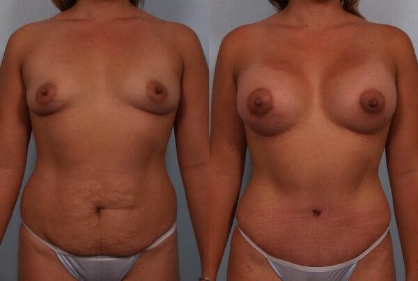 Breast Lift (Mastopexy) 56