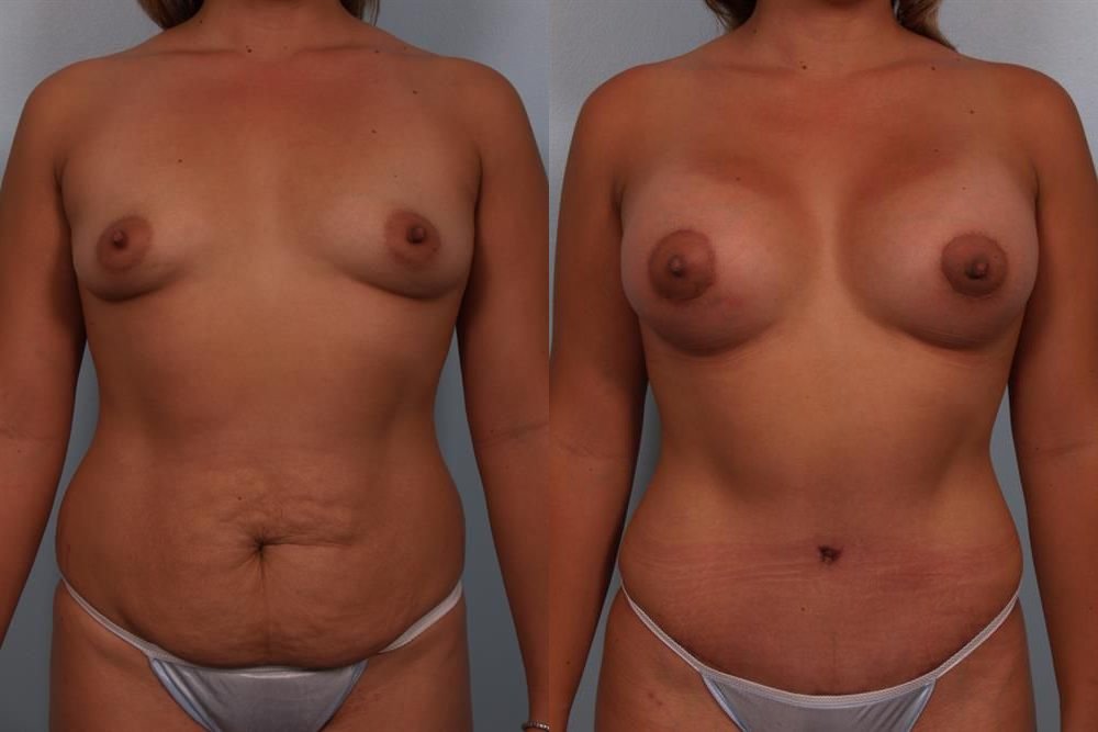 Breast Lift (Mastopexy) 56