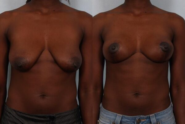 Breast Lift (Mastopexy) 57