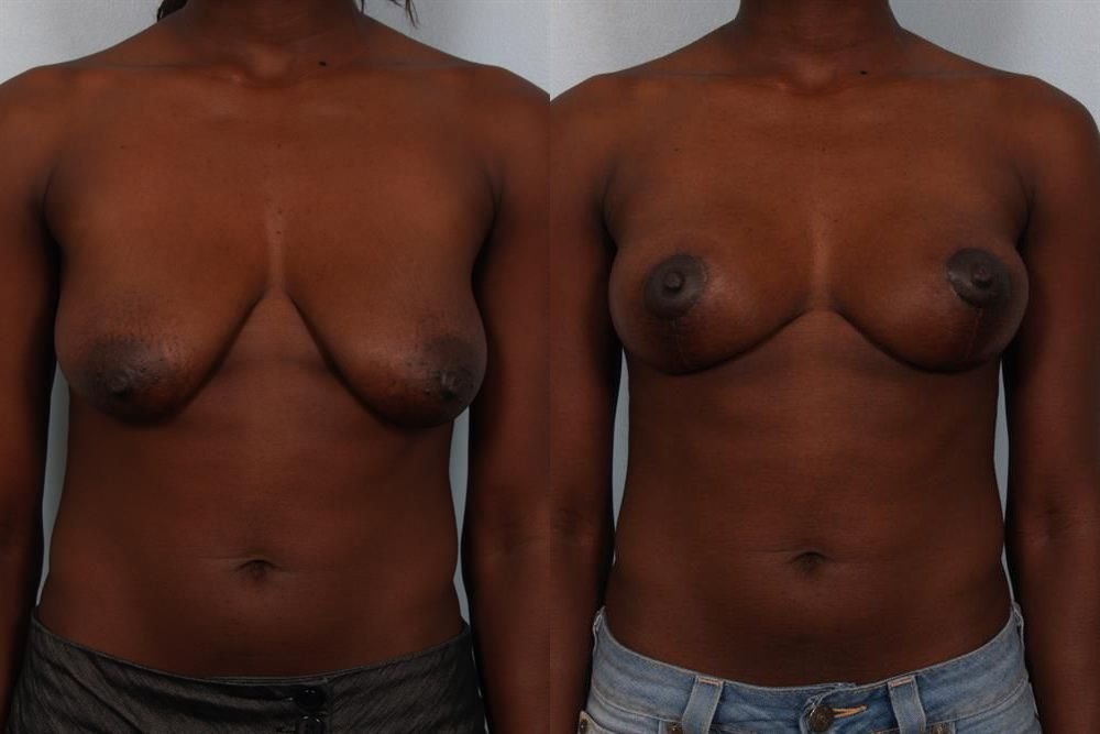 Breast Lift (Mastopexy) 57