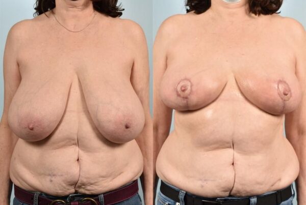 Breast Lift (Mastopexy) 58