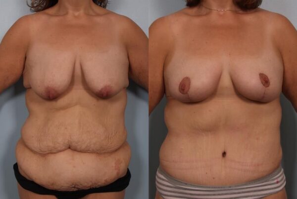 Breast Lift (Mastopexy) 59