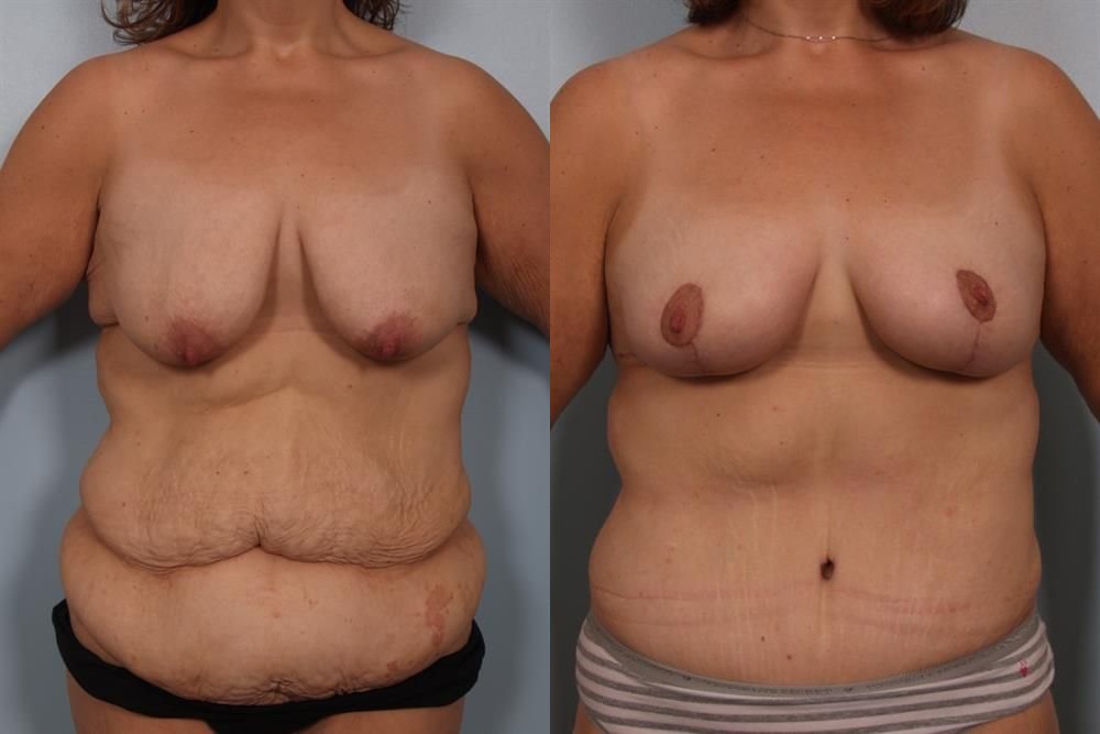 Breast Lift (Mastopexy) 59