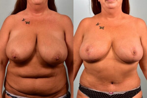 Breast Lift (Mastopexy) 6