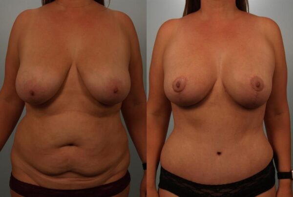 Breast Lift (Mastopexy) 60