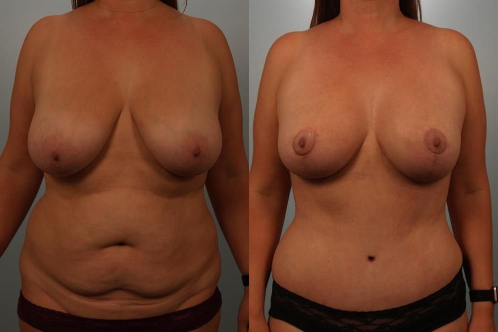 Breast Lift (Mastopexy) 60