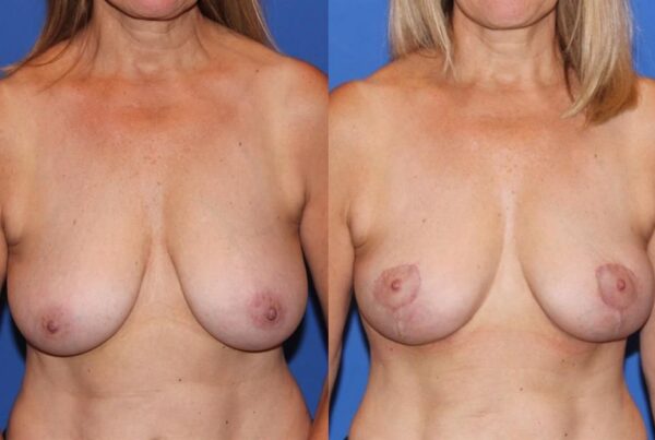 Breast Lift (Mastopexy) 61