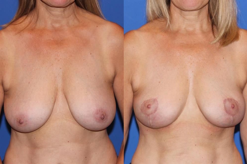 Breast Lift (Mastopexy) 61