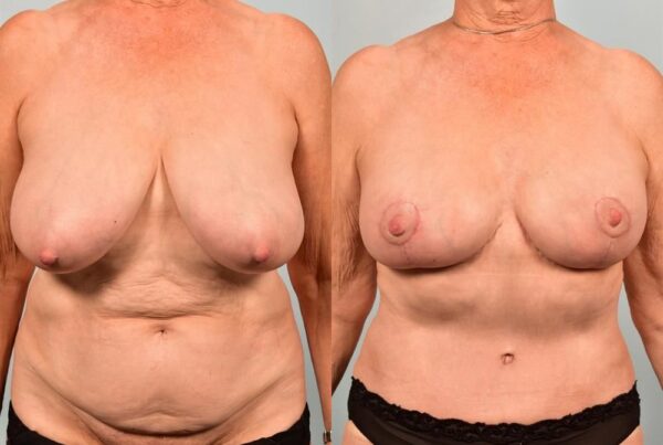 Breast Lift (Mastopexy) 62