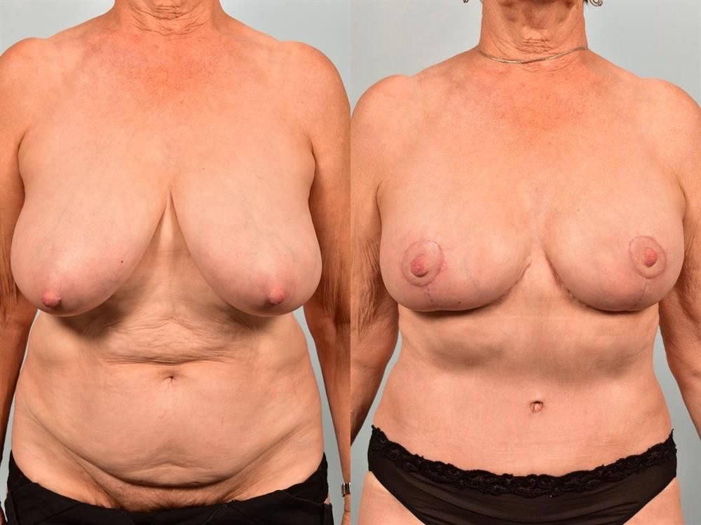 Breast Lift (Mastopexy) 62
