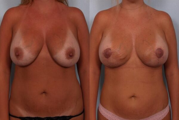 Breast Lift (Mastopexy) 63