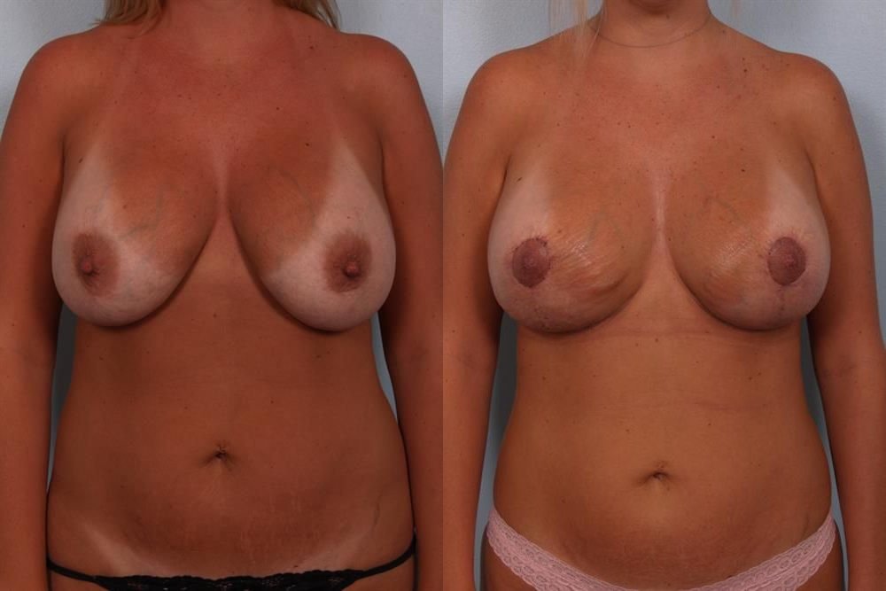 Breast Lift (Mastopexy) 63