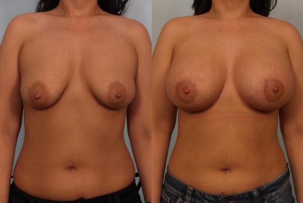 Breast Lift (Mastopexy) 64