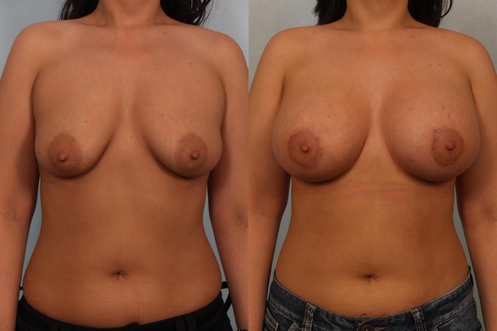 Breast Lift (Mastopexy) 64