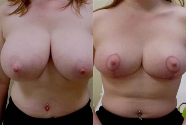Breast Lift (Mastopexy) 65