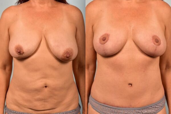 Breast Lift (Mastopexy) 67