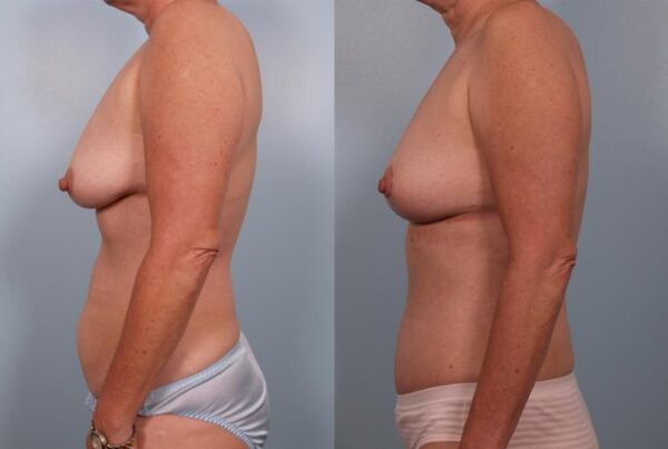 Breast Lift (Mastopexy) 68
