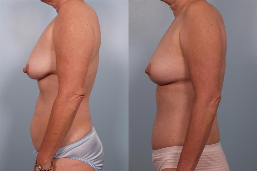 Breast Lift (Mastopexy) 68