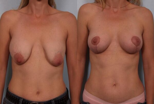 Breast Lift (Mastopexy) 69