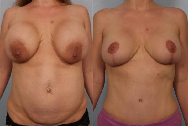 Breast Lift (Mastopexy) 7