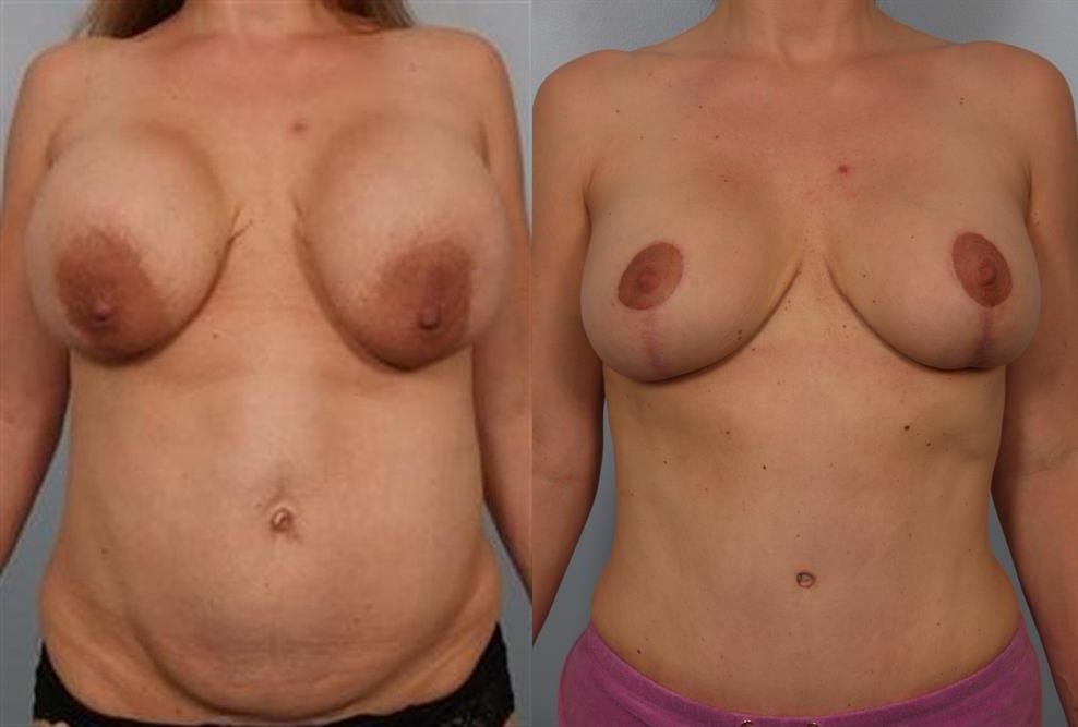 Breast Lift (Mastopexy) 7