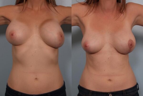 Breast Lift (Mastopexy) 70