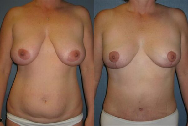 Breast Lift (Mastopexy) 71