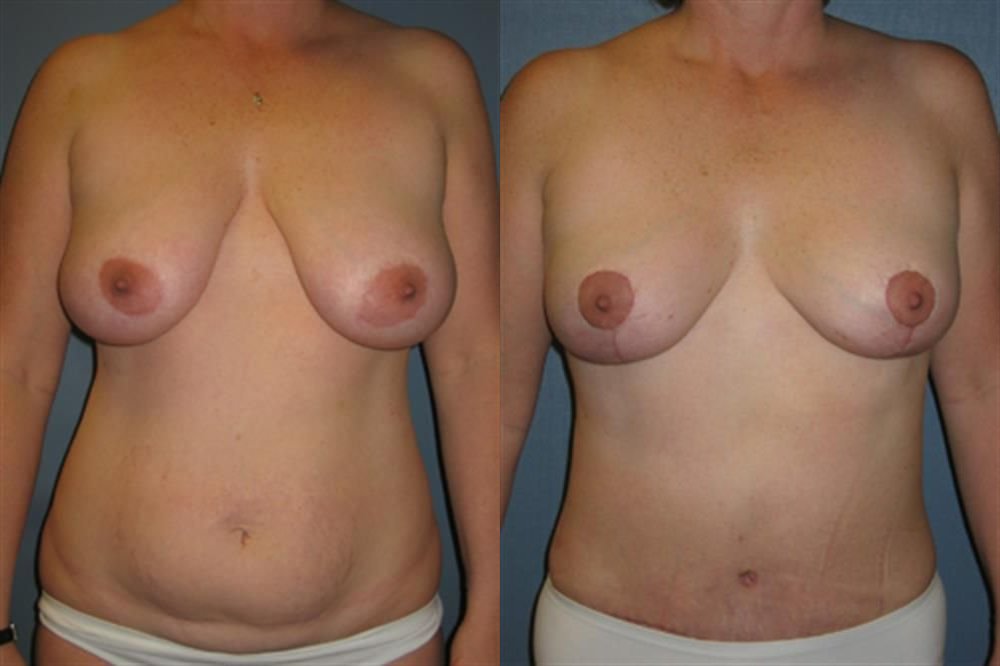Breast Lift (Mastopexy) 71