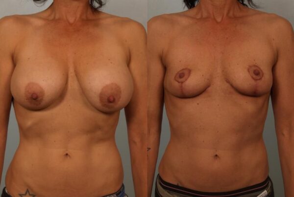 Breast Lift (Mastopexy) 72