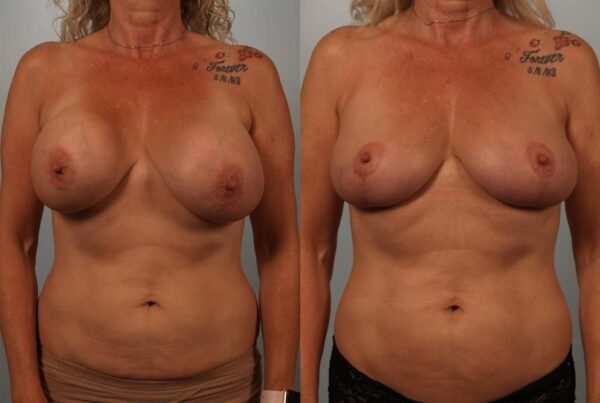 Breast Lift (Mastopexy) 73