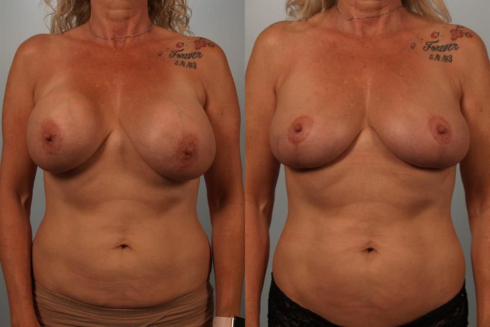 Breast Lift (Mastopexy) 73