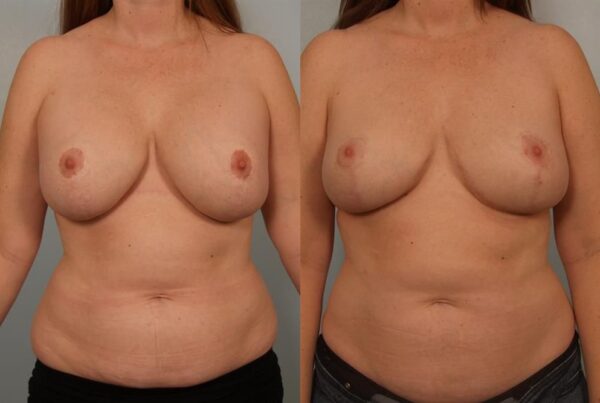 Breast Lift (Mastopexy) 74