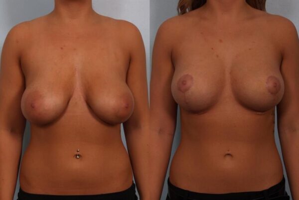Breast Lift (Mastopexy) 75