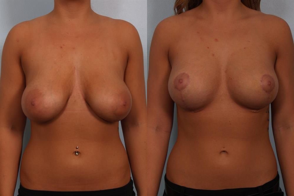 Breast Lift (Mastopexy) 75