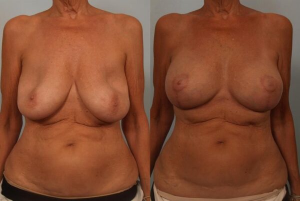 Breast Lift (Mastopexy) 76