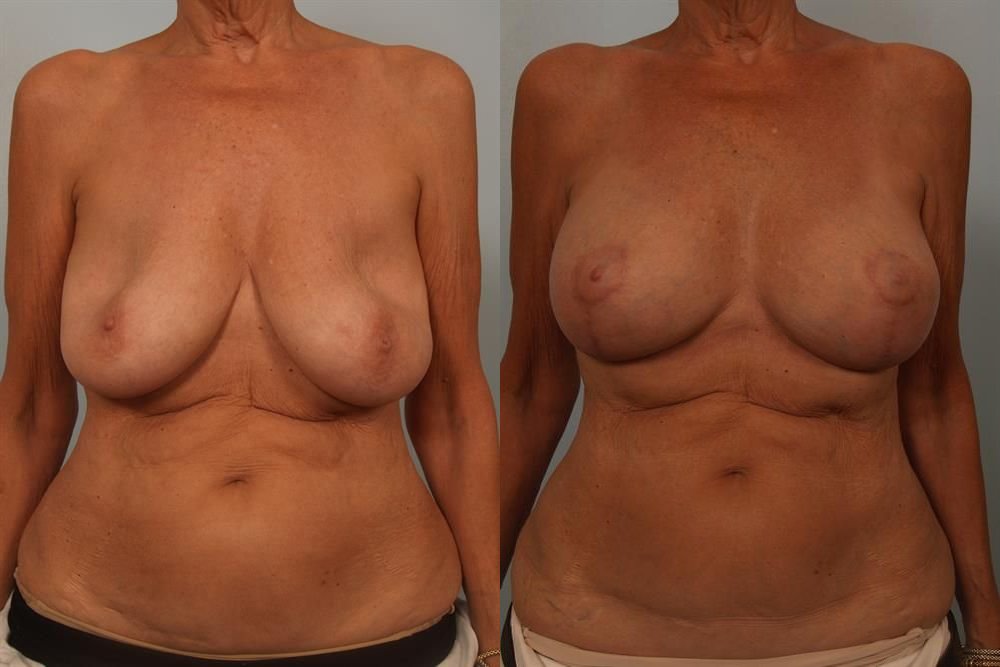 Breast Lift (Mastopexy) 76