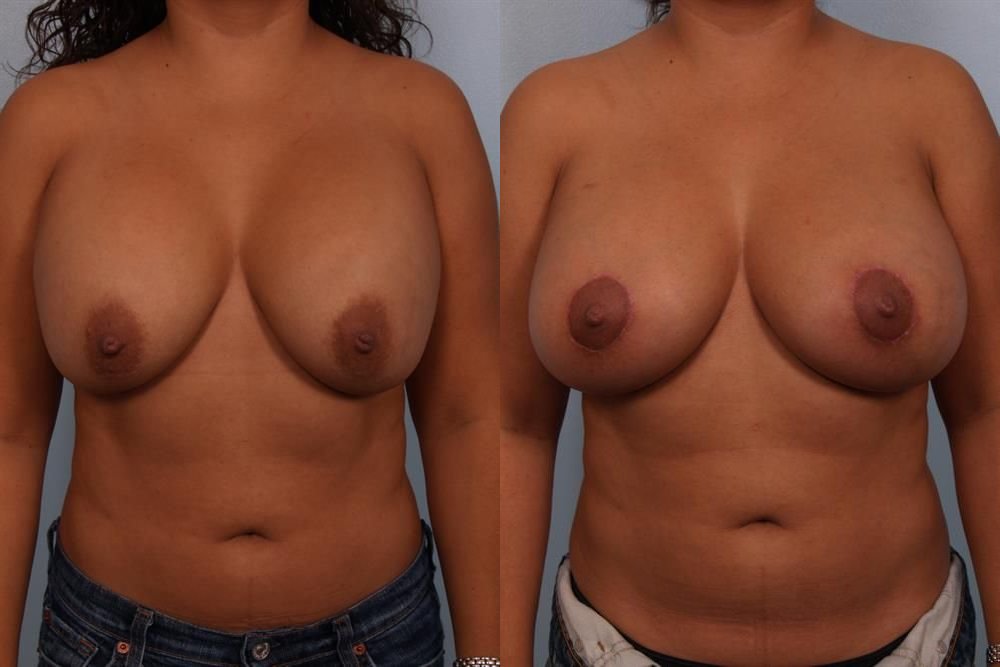 Breast Lift (Mastopexy) 77