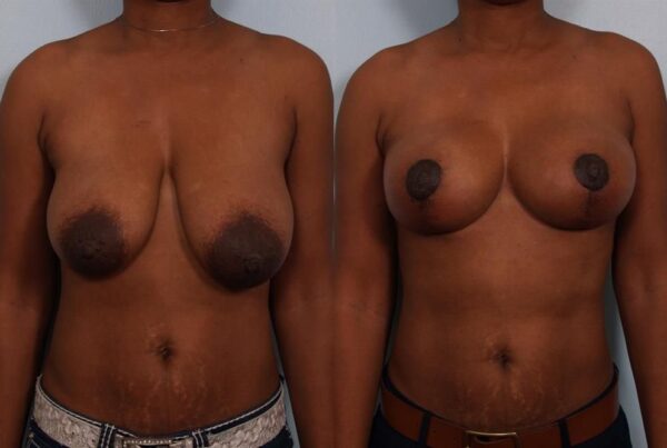 Breast Lift (Mastopexy) 78