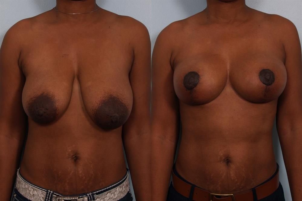 Breast Lift (Mastopexy) 78